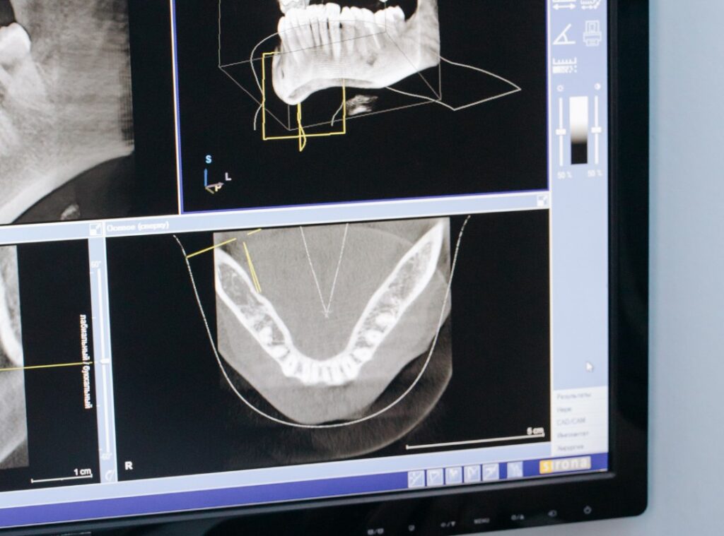 CAD/CAM dental treatment at Afyon Ballıpınar Dental Clinic – fast and precise dental crown production using digital technology.