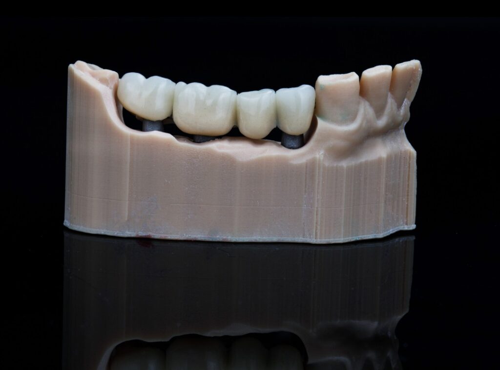 Dental bridge treatment at Afyon Ballıpınar Dental Clinic – aesthetic and functional bridge application to replace missing teeth.