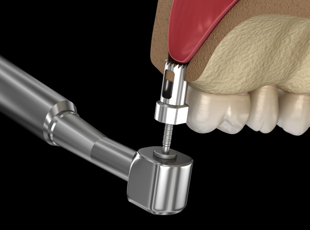 Sinus lift treatment at Afyon Ballıpınar Dental Clinic – a surgical method to increase bone volume before dental implant placement.