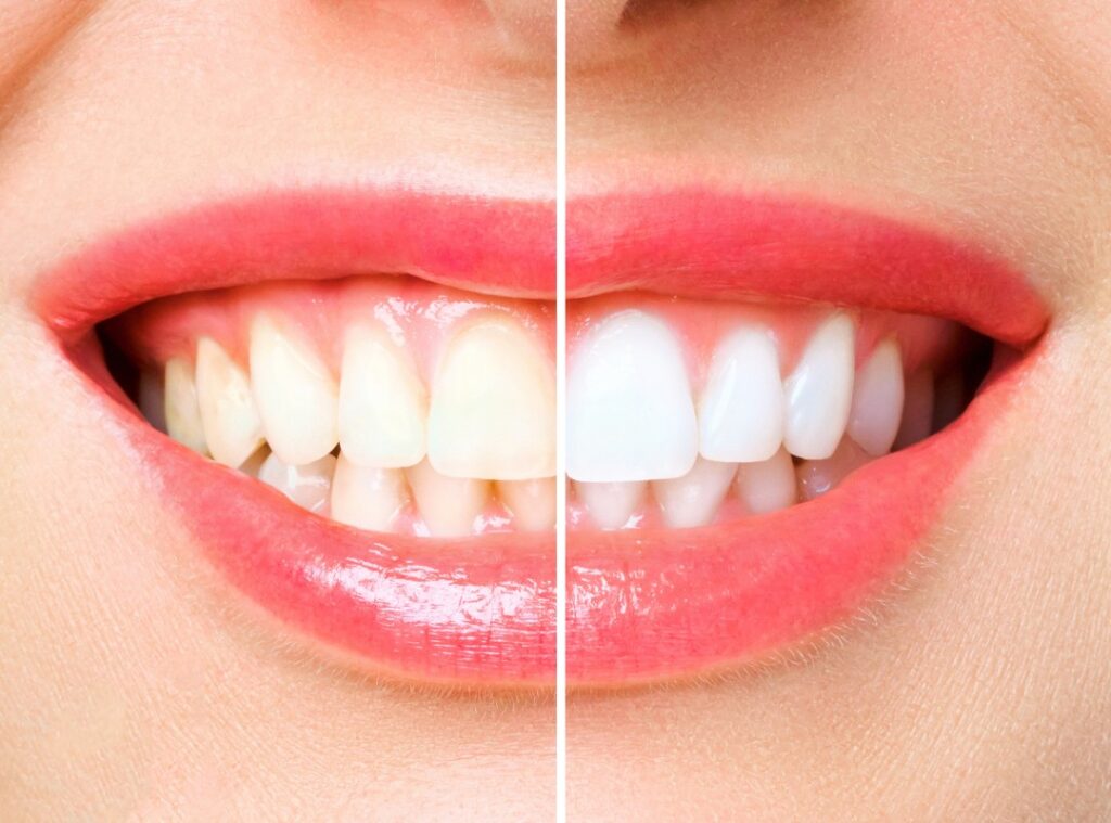 Teeth whitening treatment at Afyon Ballıpınar Dental Clinic – professional bleaching for a brighter and whiter smile.